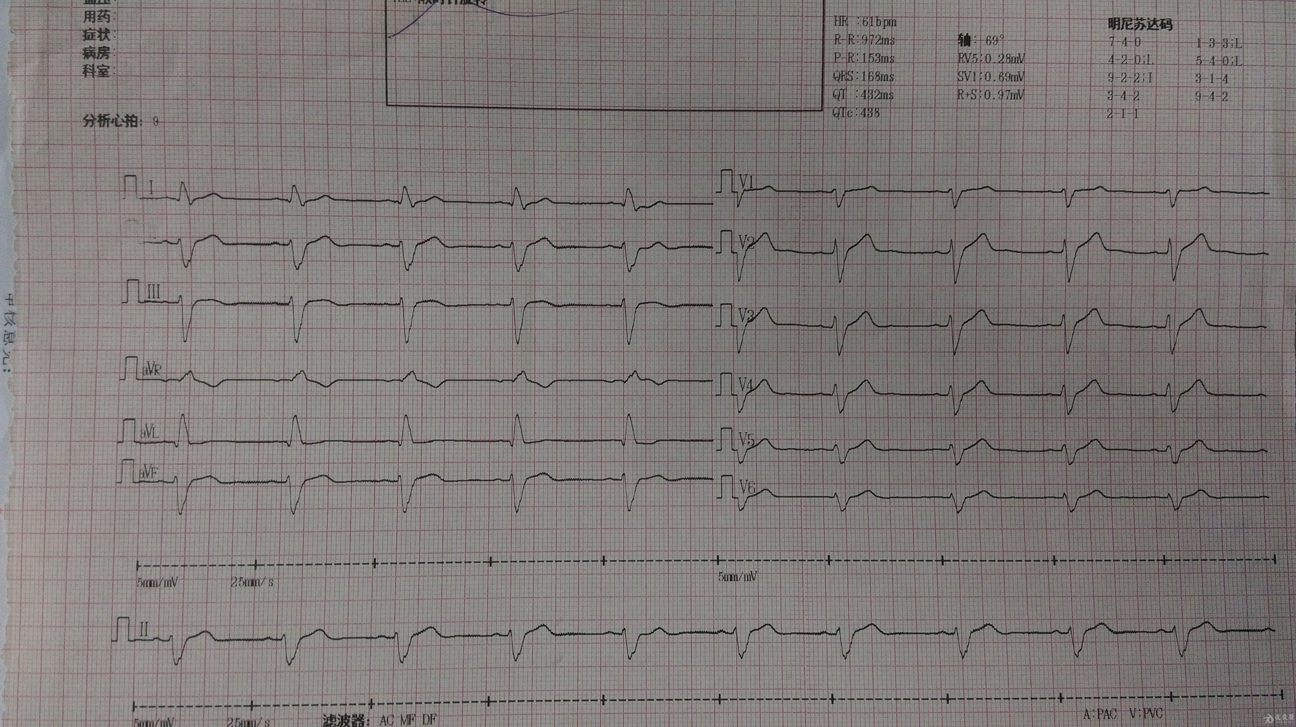 这是我个人的一份心电图检测报告提供学习并望答疑