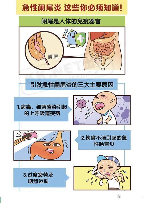 急性阑尾炎 这些你必须知道!