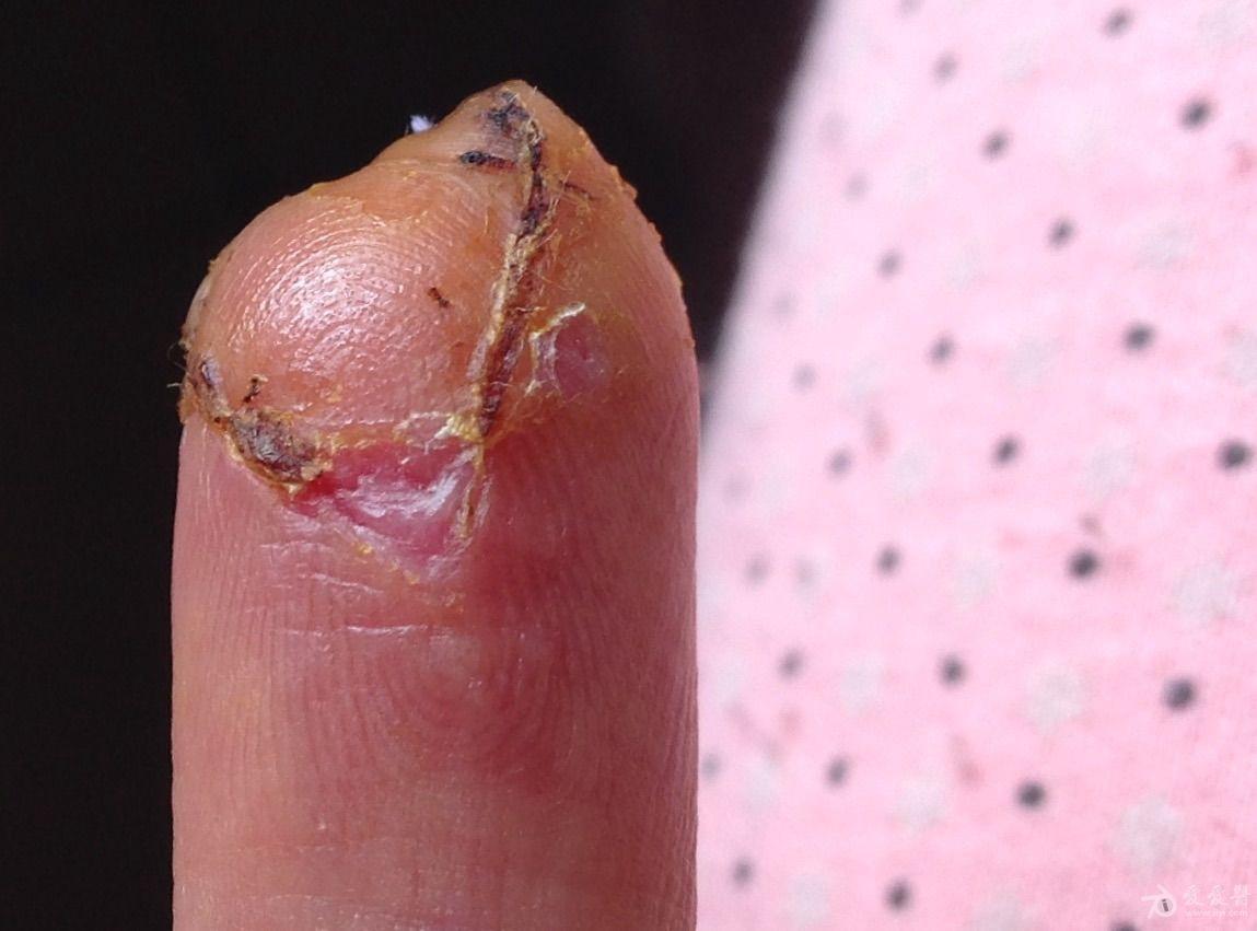 这个指甲会怎么长肉还有机会长饱满吗