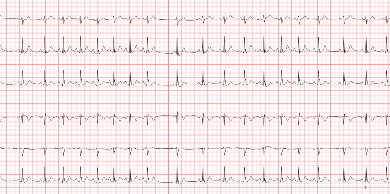 冬秋-心电图讨论-20150329-心律不齐
