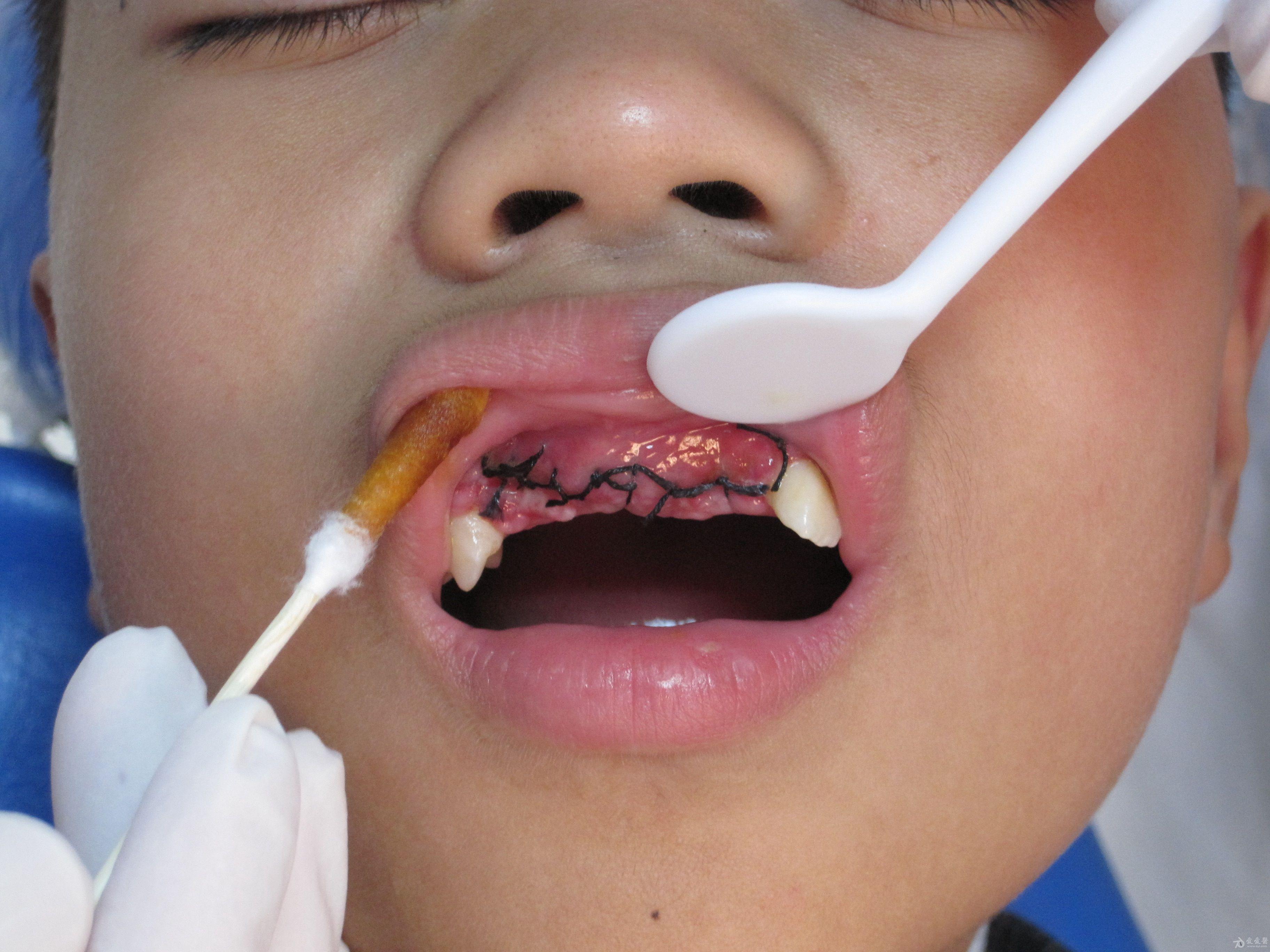小孩牙龈瘤图片图片