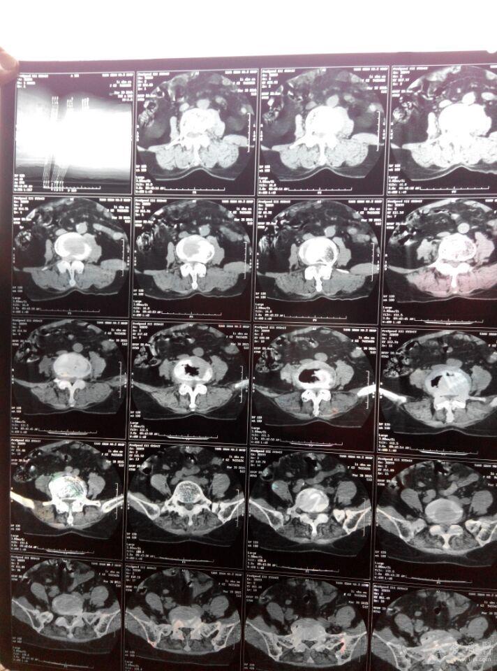 帮忙看下ct片子