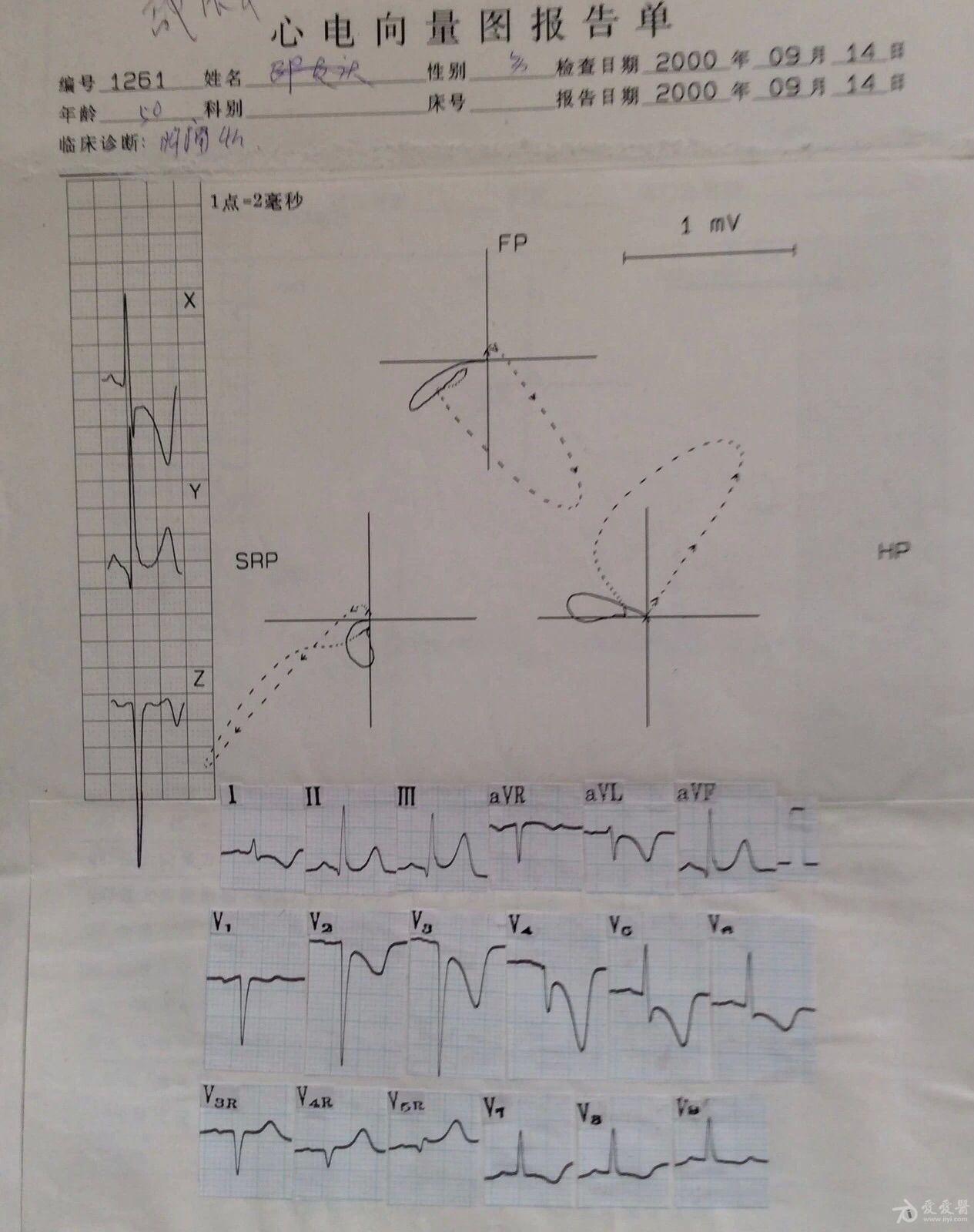 心电向量图图解 报告图片