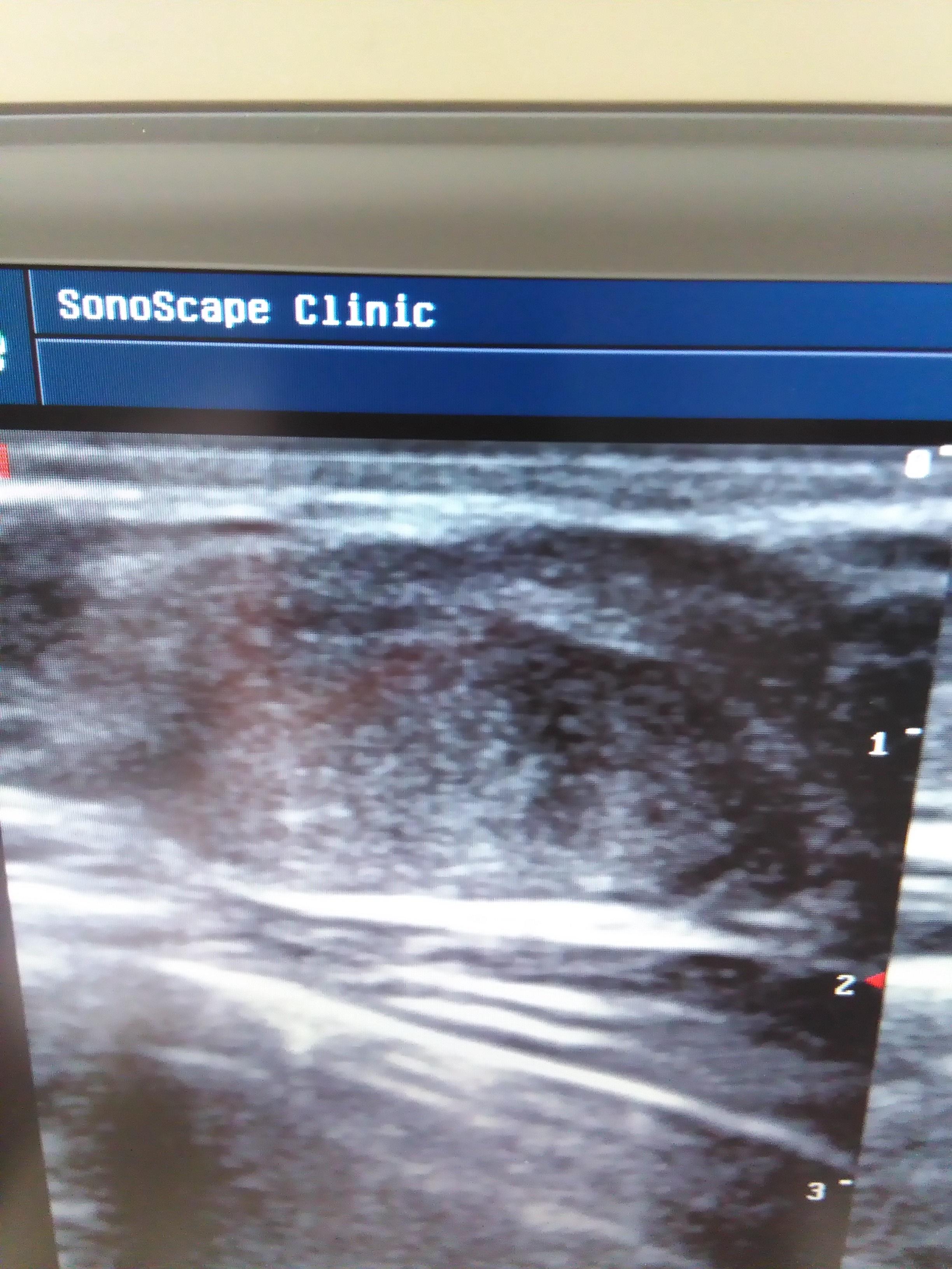 大家帮忙看看是不是纤维瘤 - 超声医学讨论版 - 爱爱医医学论坛