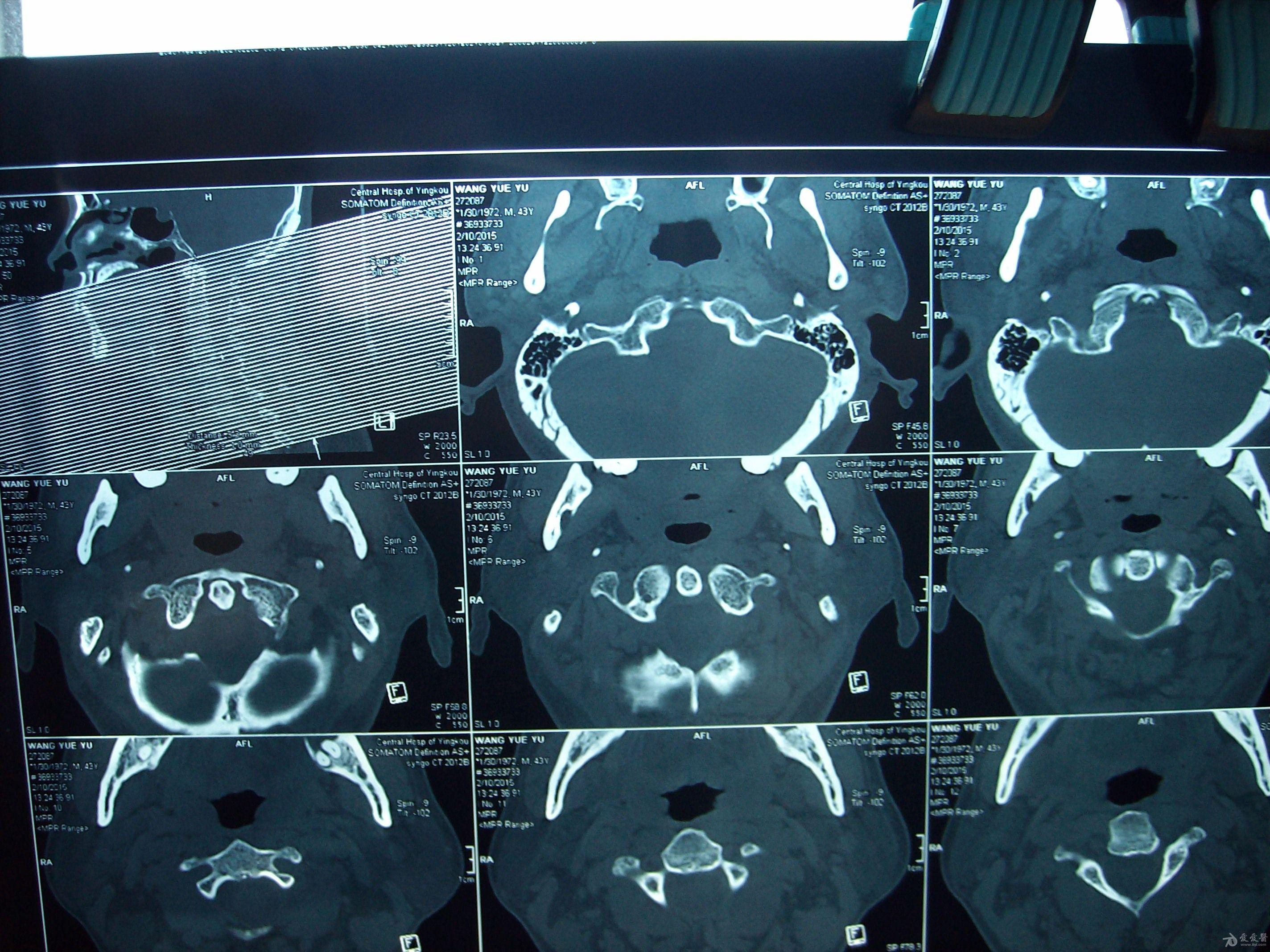 枕骨颞骨有骨折吗