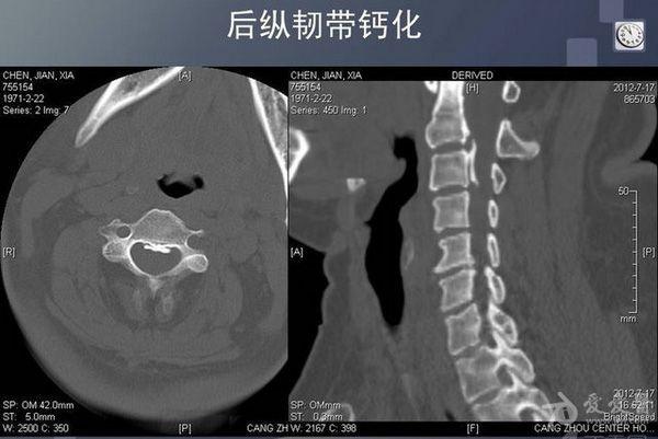后纵韧带钙化1.jpg