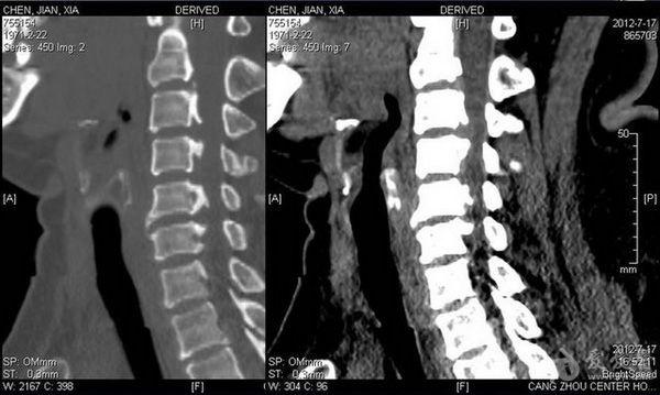 颈椎项韧带钙化图片图片