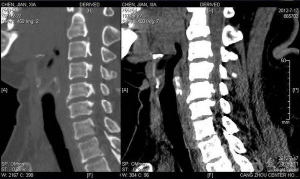 颈椎项韧带钙化图片ct图片