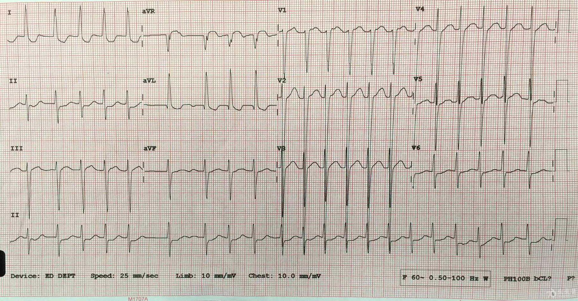 求高手帮人看看这张心电是svt 还是房颤啊?我没有看到p波.