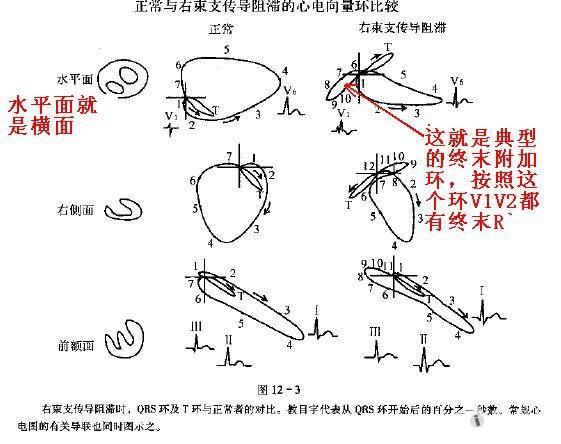 关于郭继鸿心电图学不完全性右束支阻滞图例的一点疑问