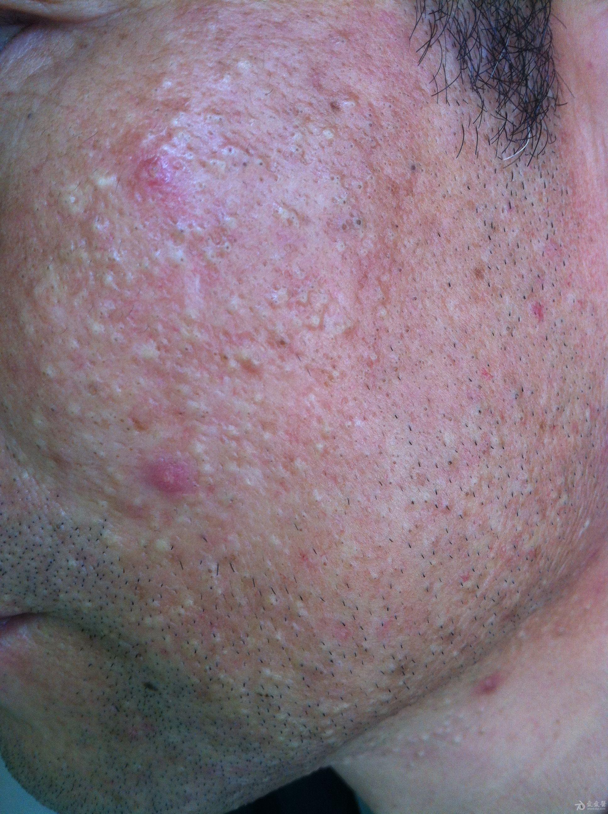 帮诊断下此顽固面部皮肤病顺便给个药方谢谢