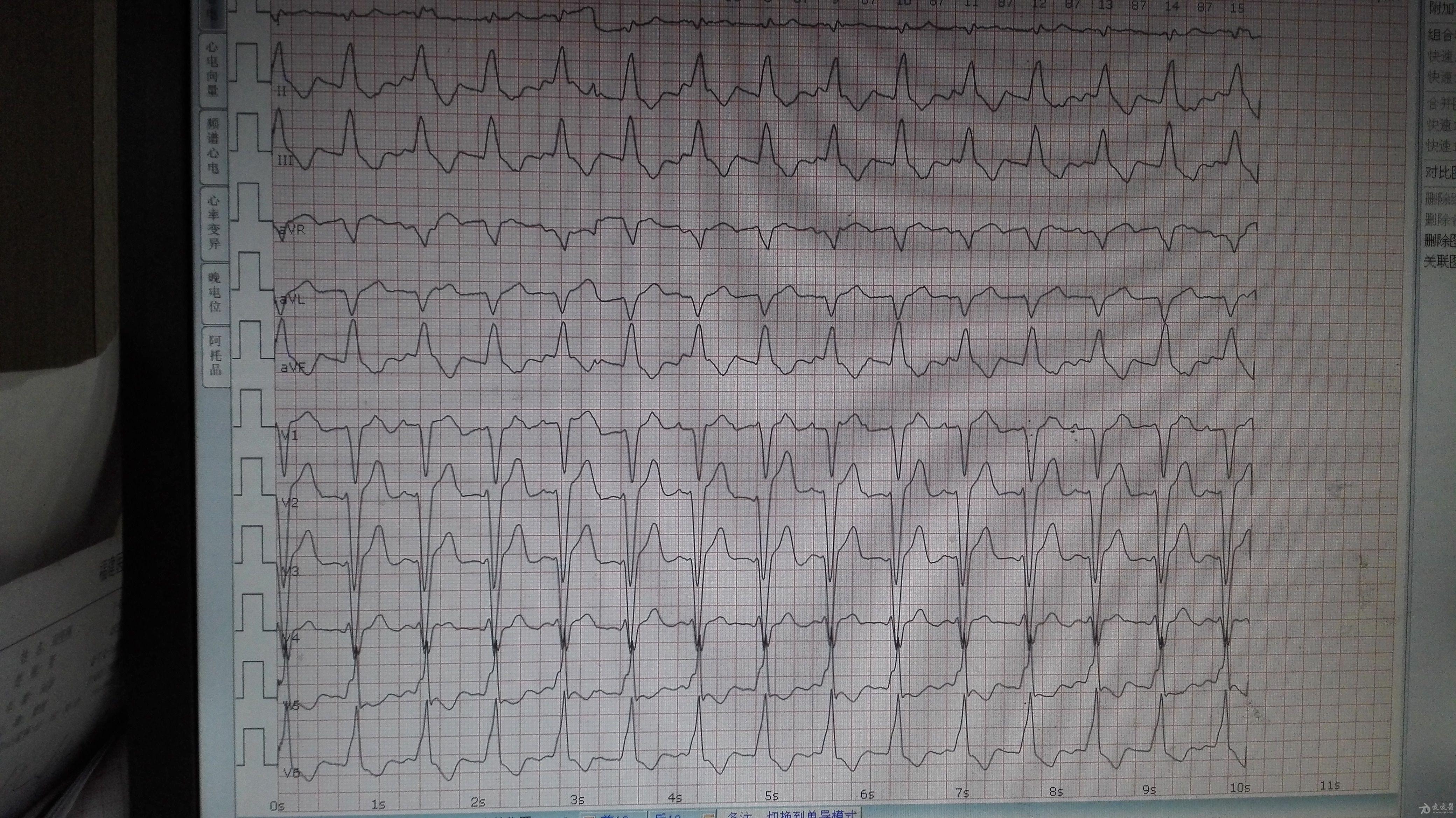 这是起搏心电图吗