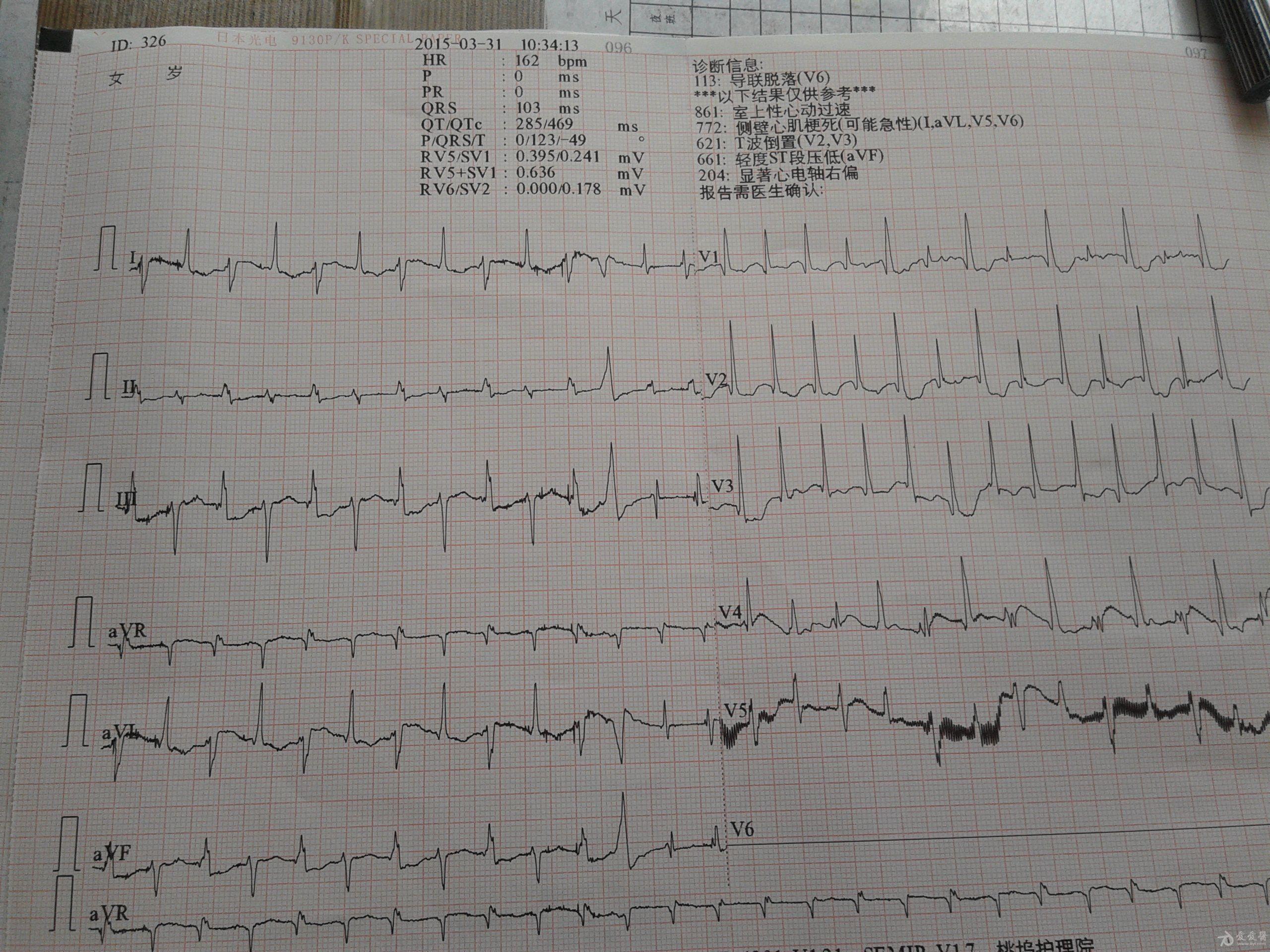 我有一心电图,请大家帮我分析分析