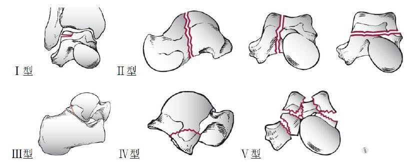 专业资源距骨骨折专题讲解