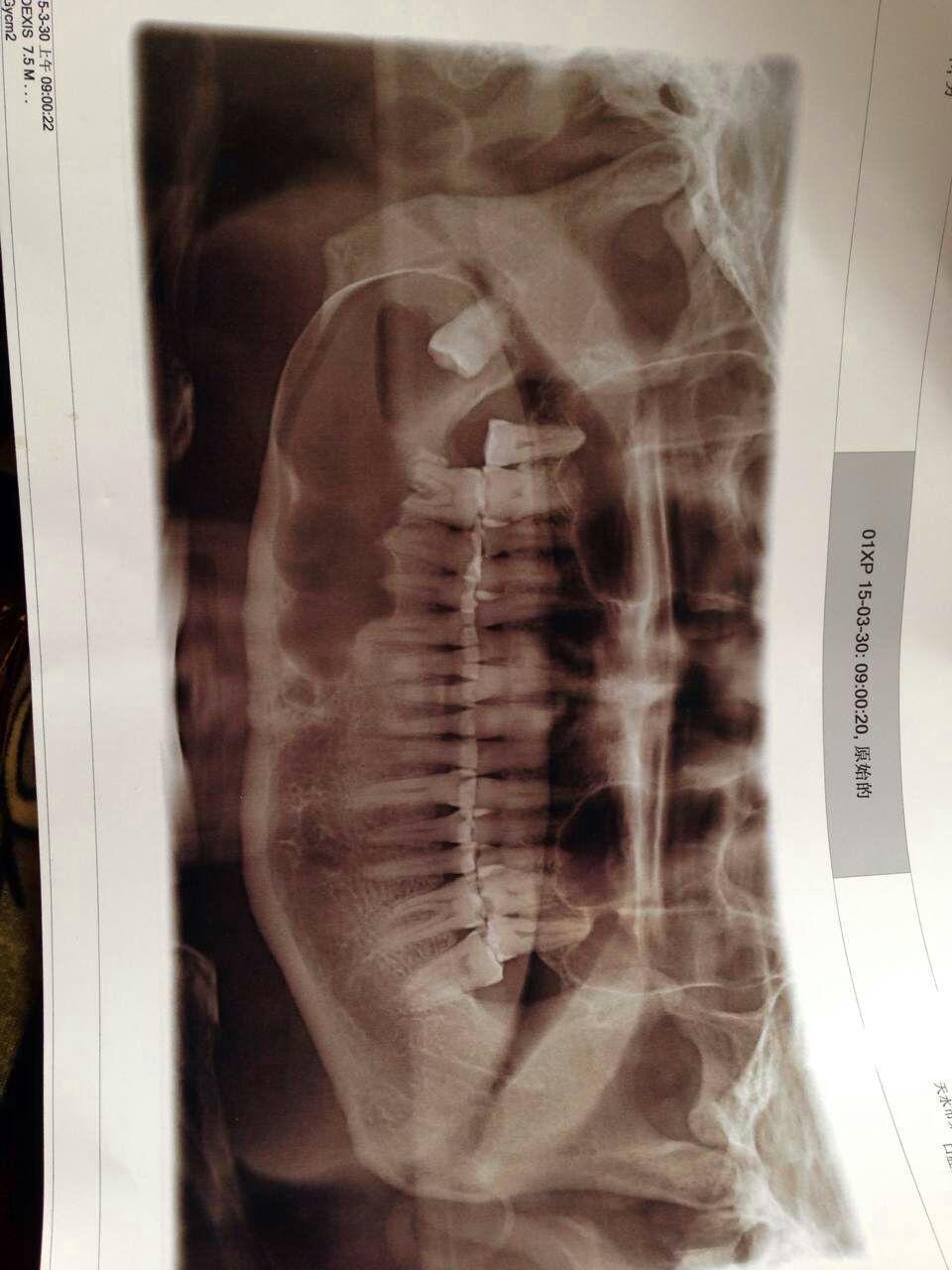 中央性颌骨骨髓炎图片图片