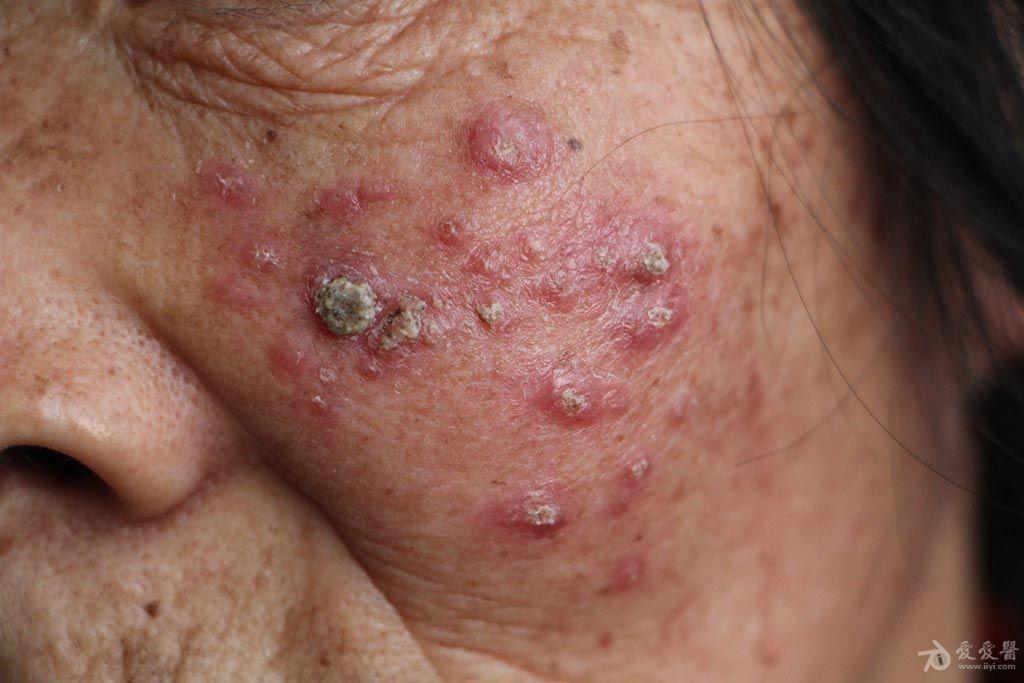 2015年皮肤版有奖病例猜答12答案孢子丝菌病