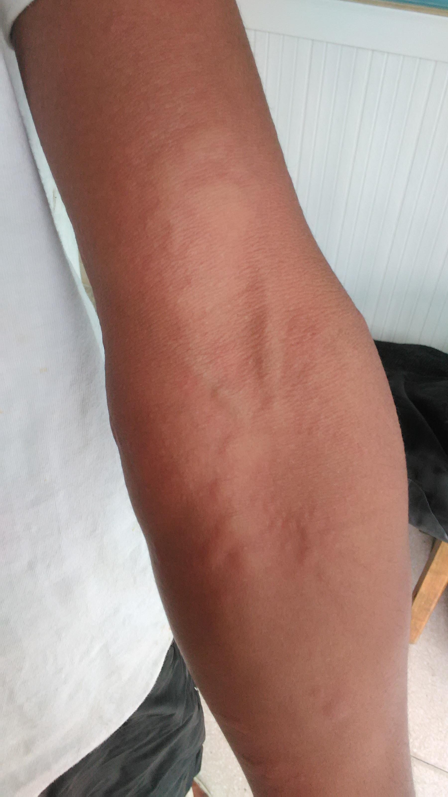 痒了三天的一个急性荨麻疹的病人