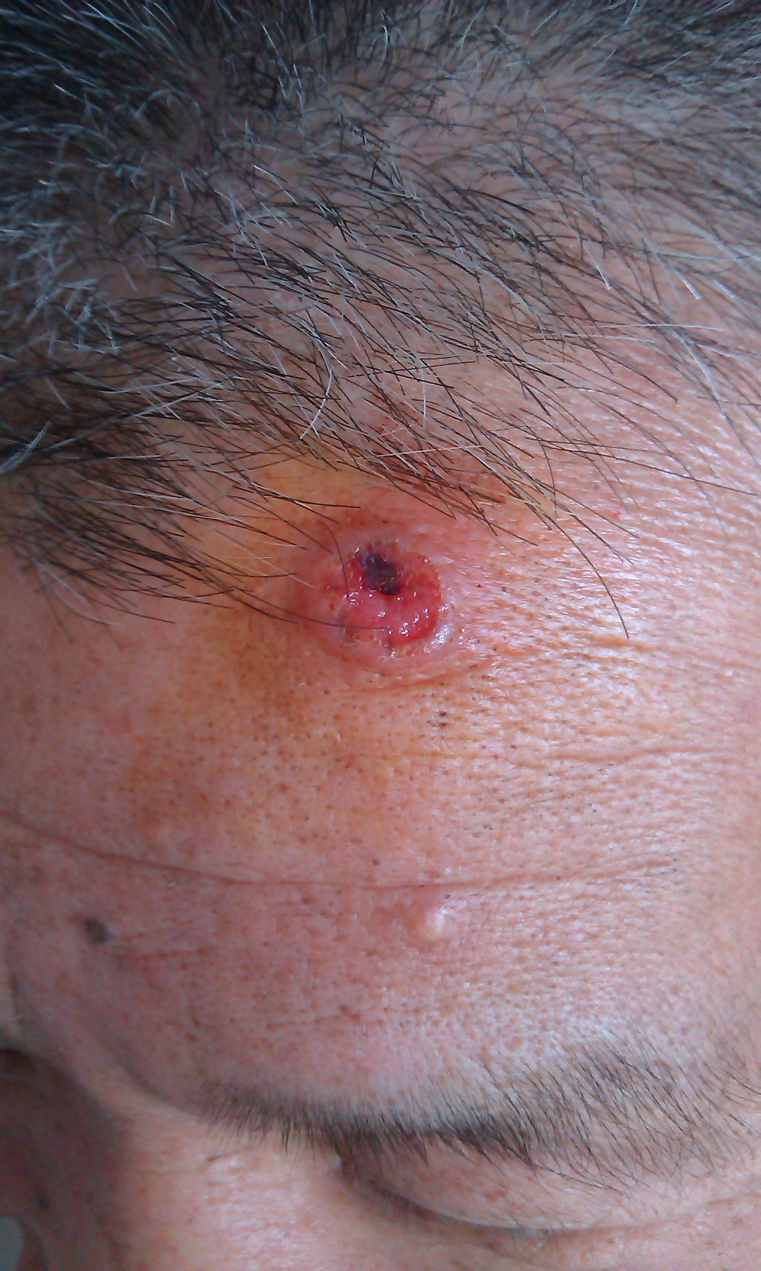 皮肤基底细胞癌早期图片