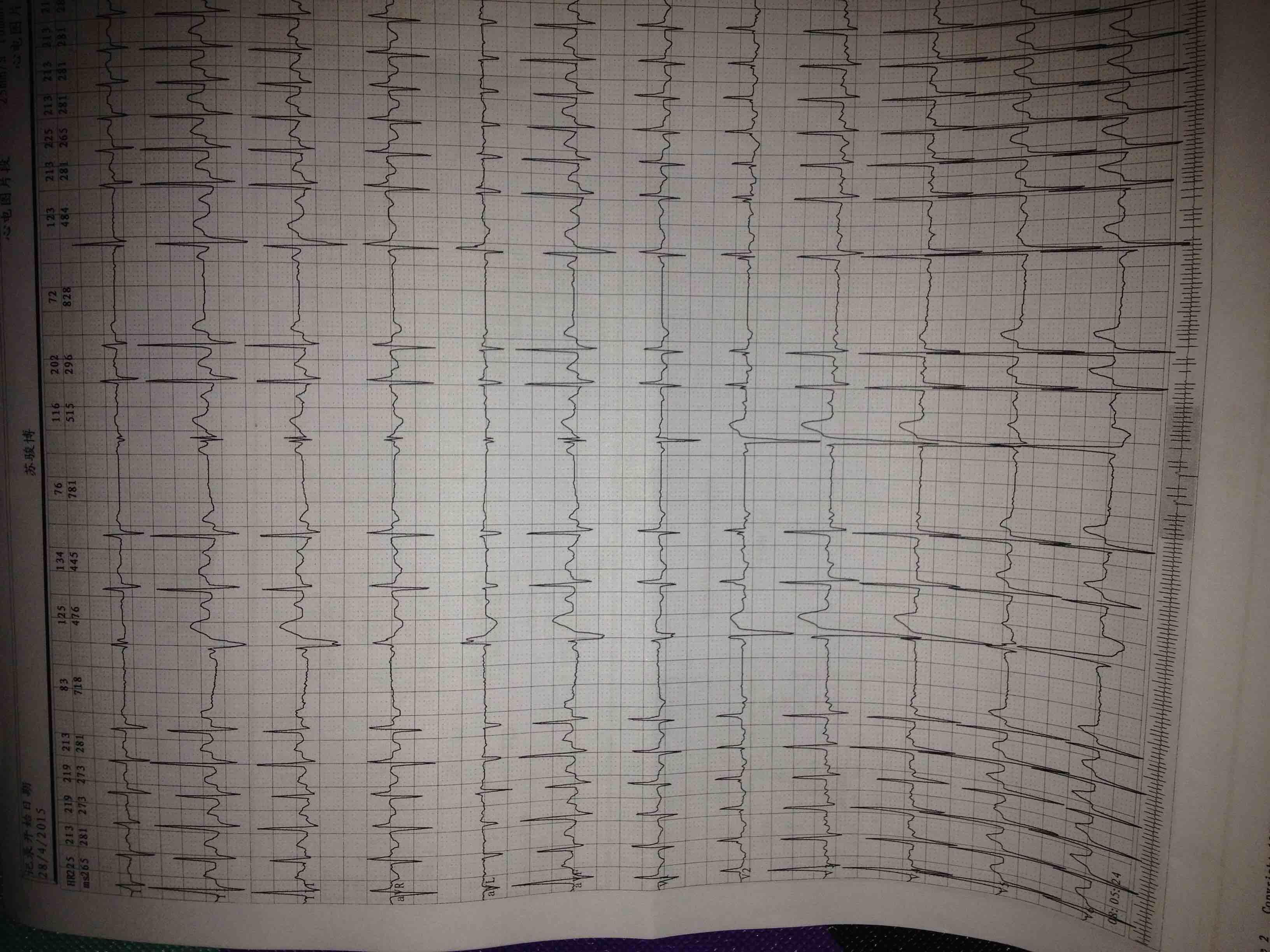 小儿心电图是有室上速以及房早未下传并形成三联律