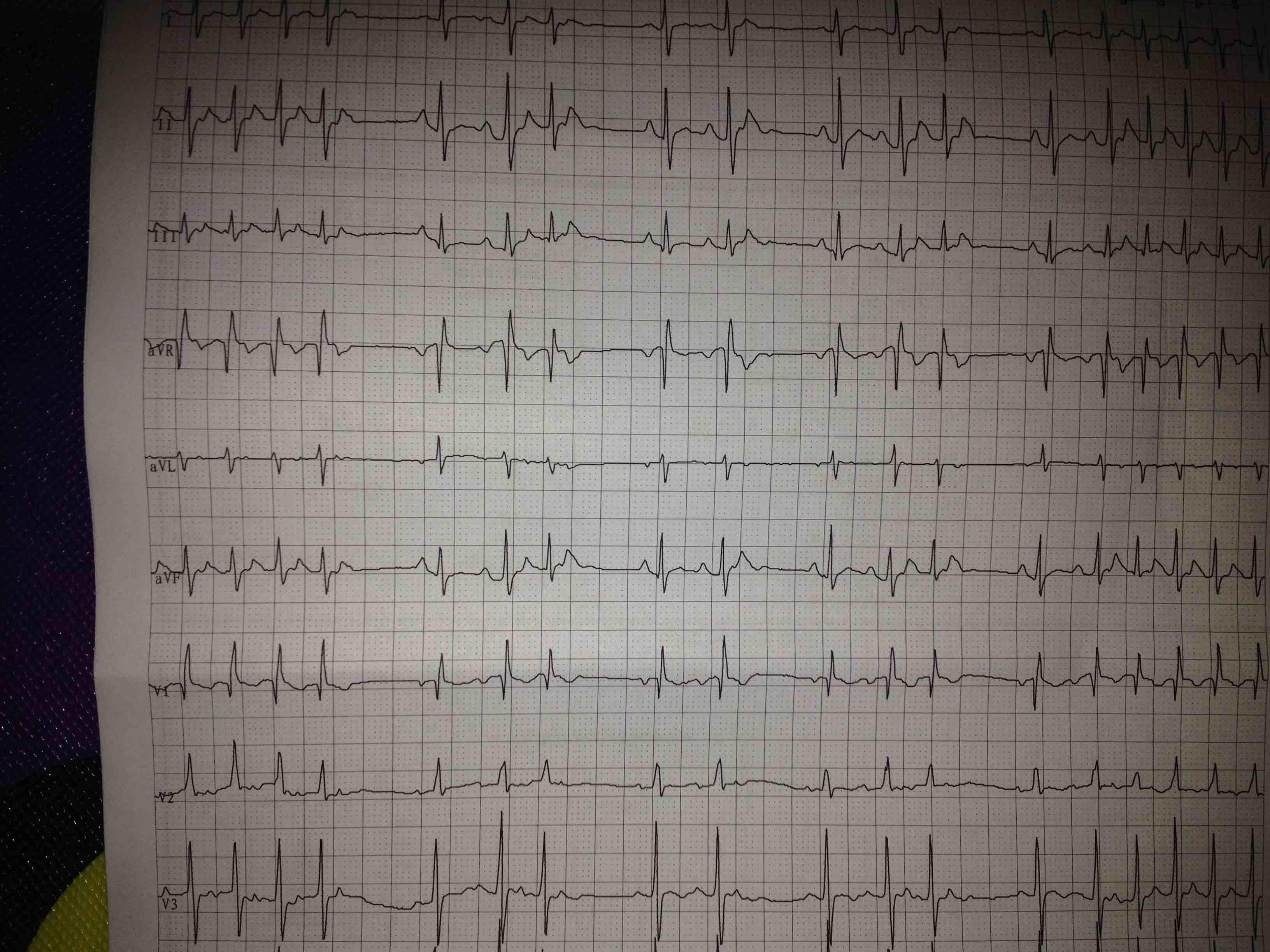 小儿心电图是有室上速以及房早未下传并形成三联律
