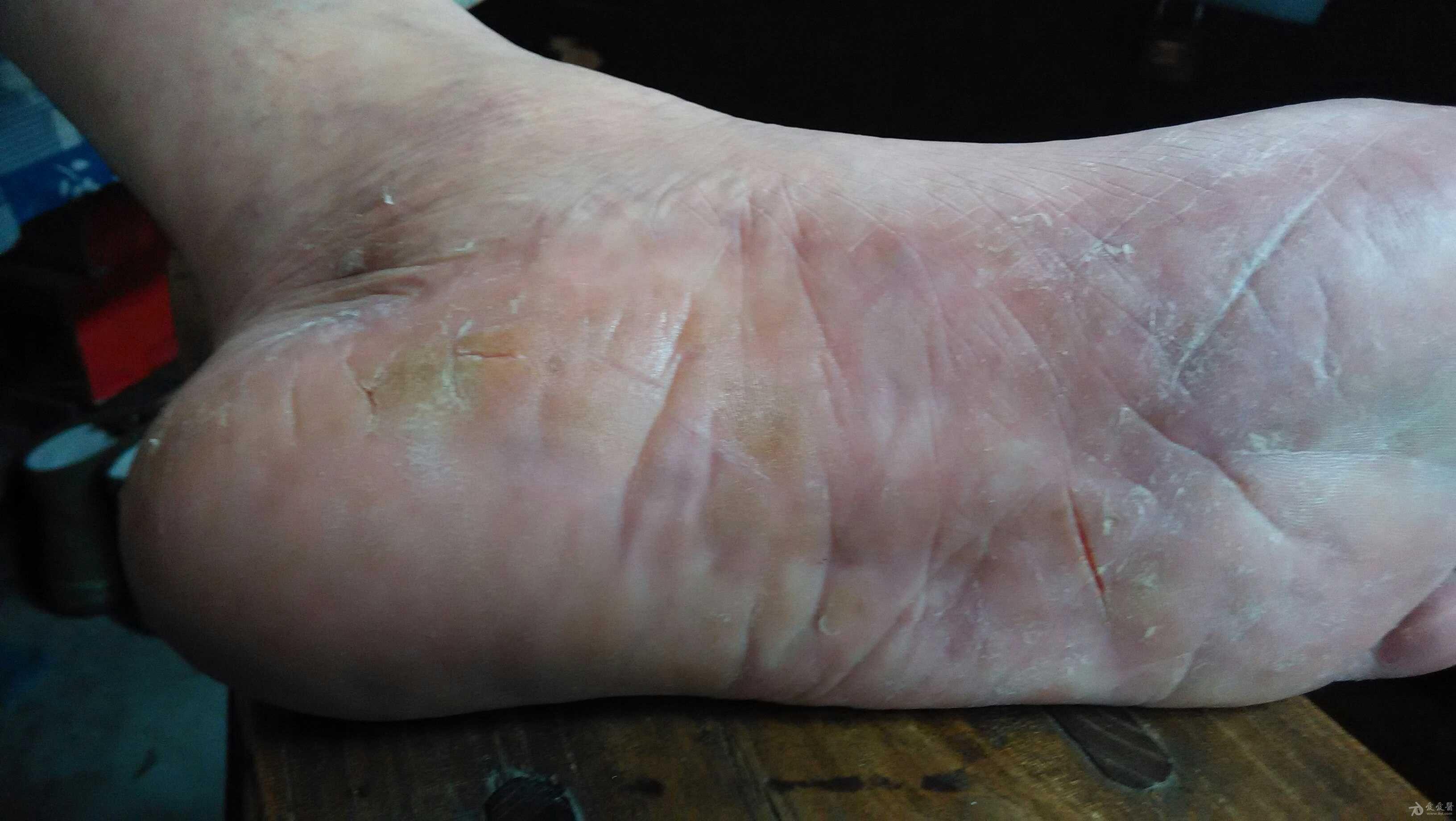 顽固的足皲裂该怎么继续治疗