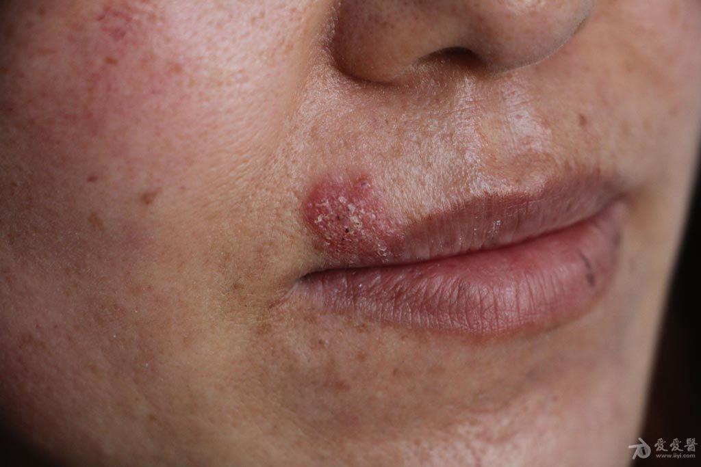 病例欣赏孢子丝菌病4