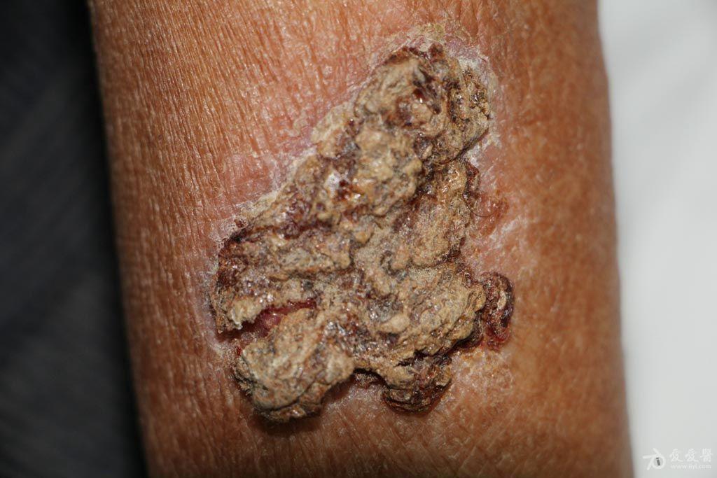 丝虫病的皮肤照片图片