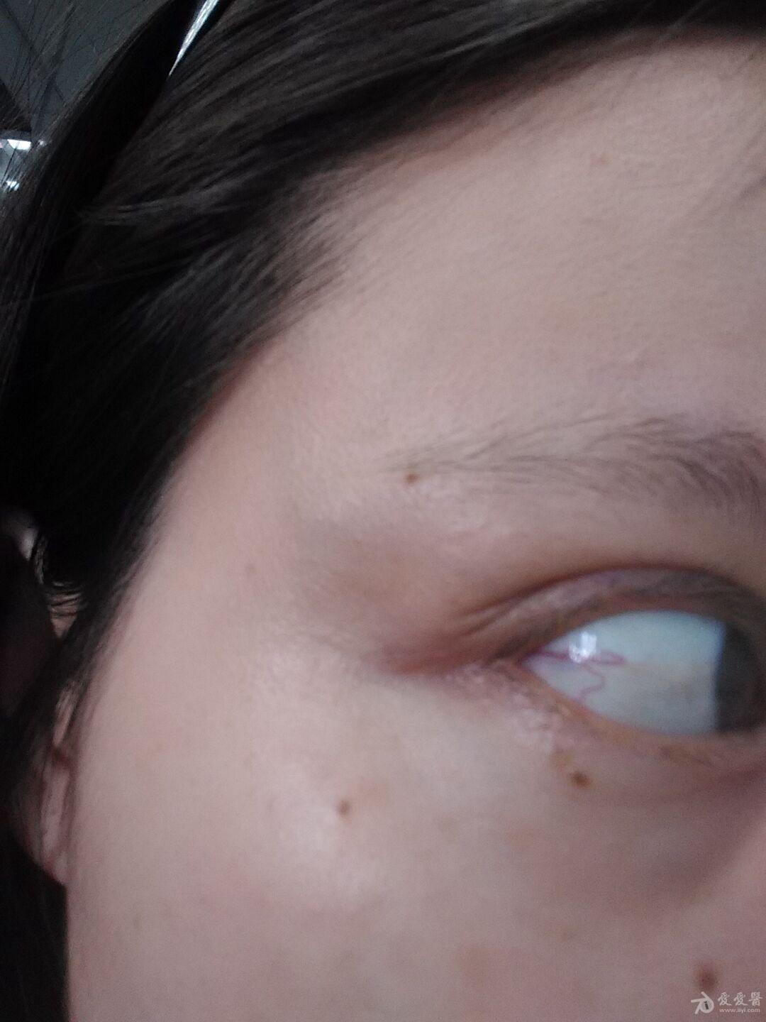 求问眼干眼涩有异物感红血丝经久不消眼角角膜褶皱是什么眼科疾病