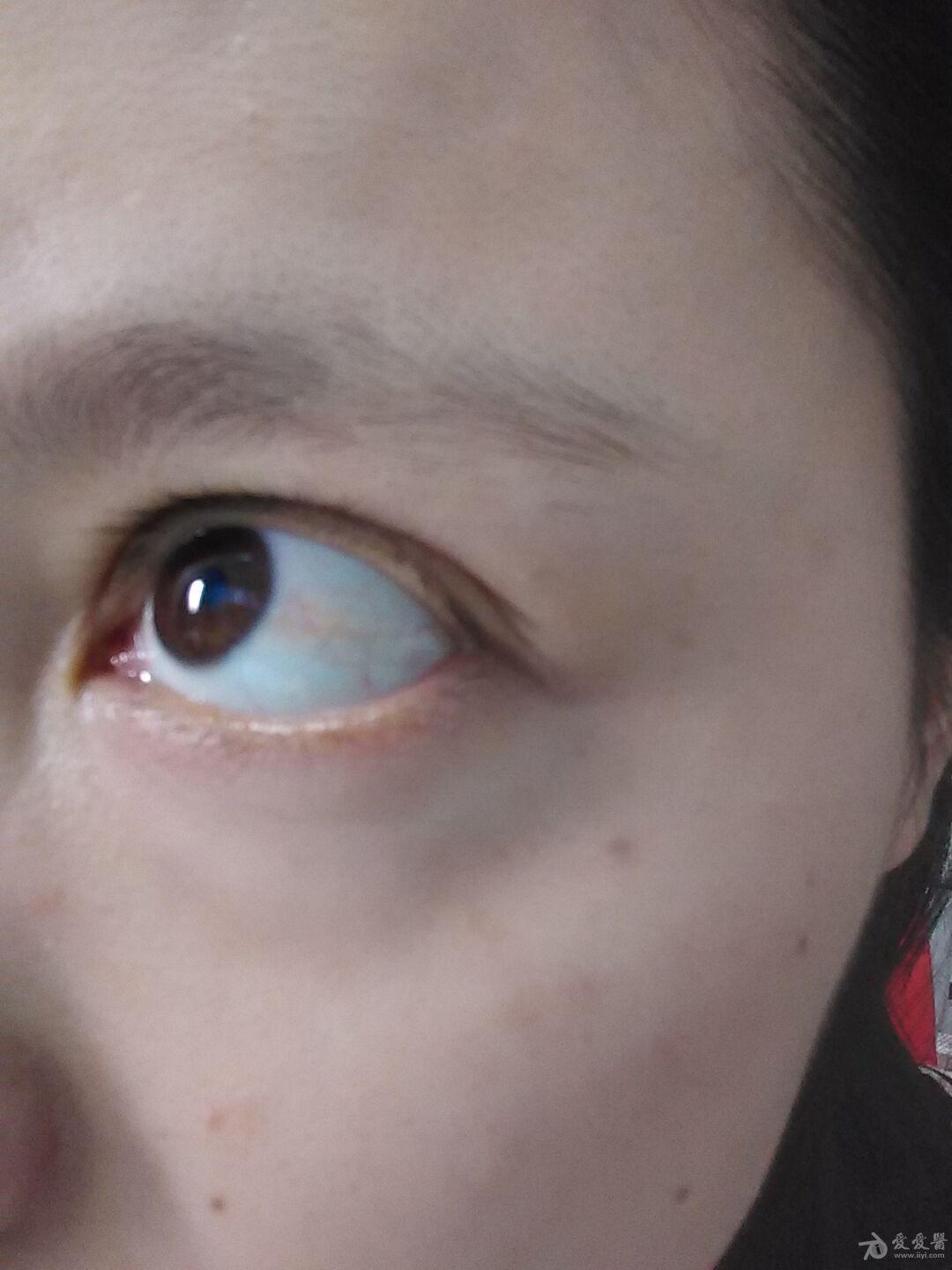 求问眼干眼涩有异物感红血丝经久不消眼角角膜褶皱是什么眼科疾病