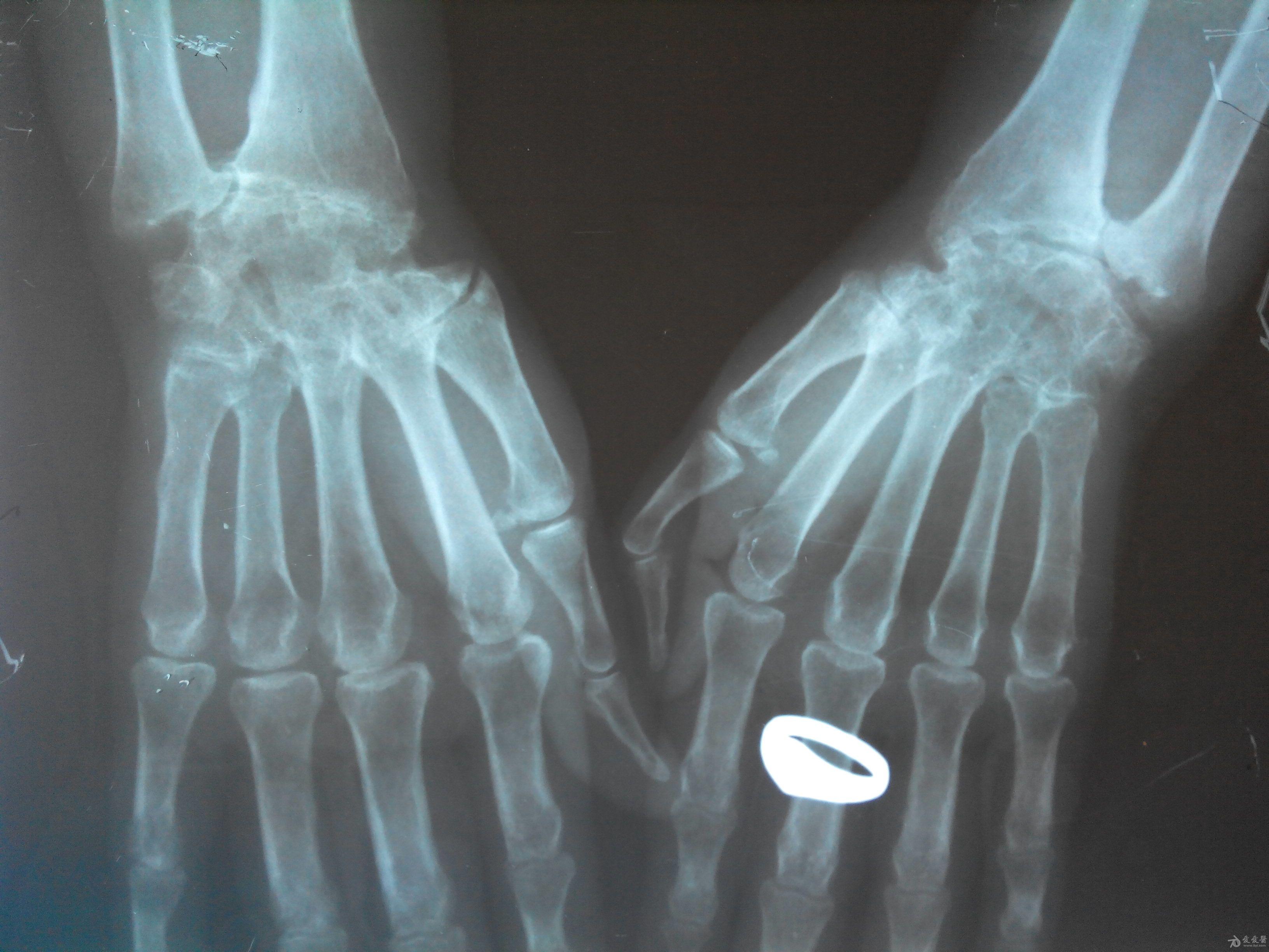 类风湿关节炎关节融合x线典型表现