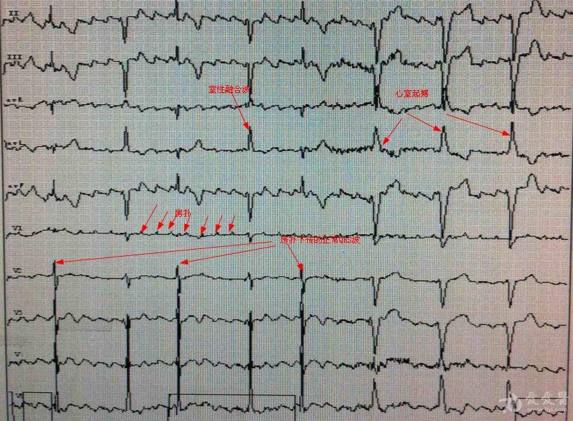 f波心电图长什么样图片