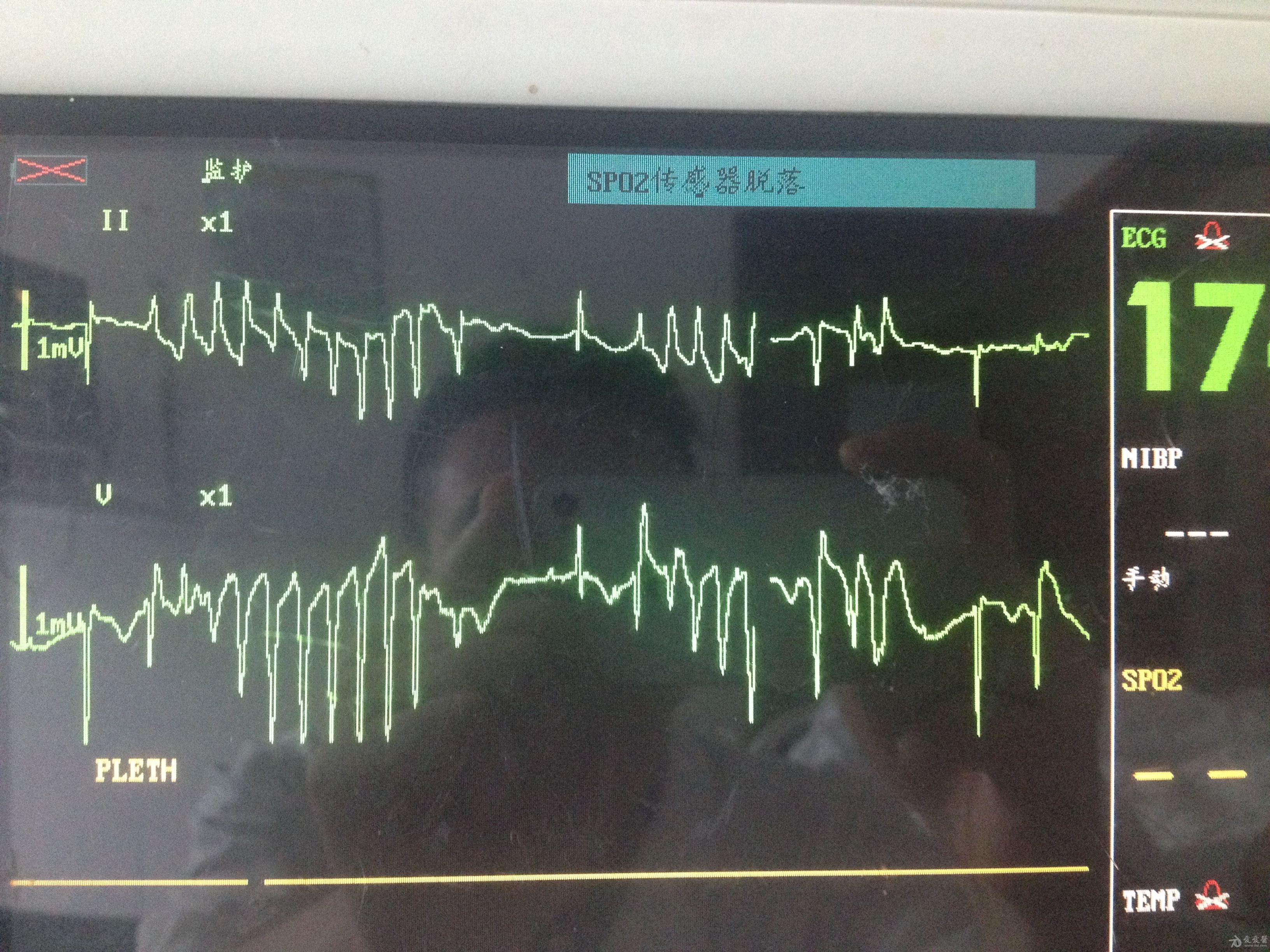 尖端扭转型室速一例