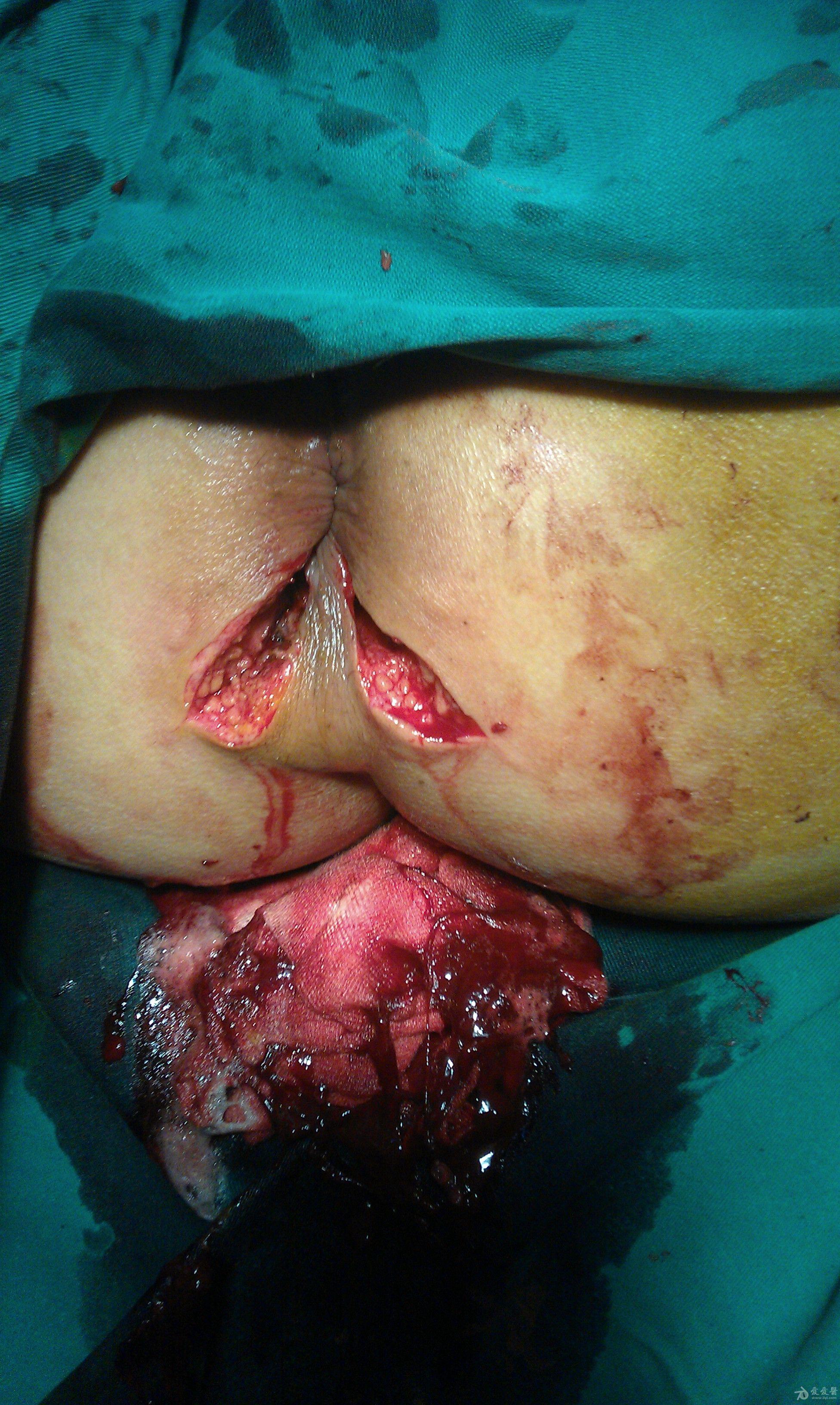 肛周脓肿的清晰图片图片