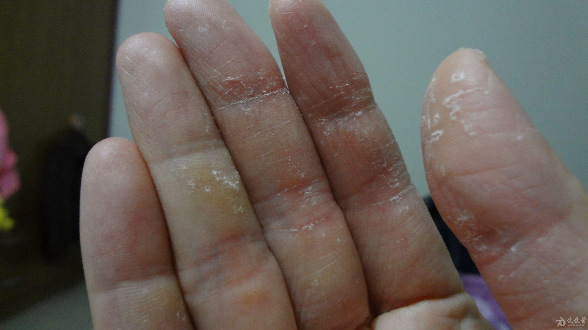 口腔医生手上皮肤病求助有图