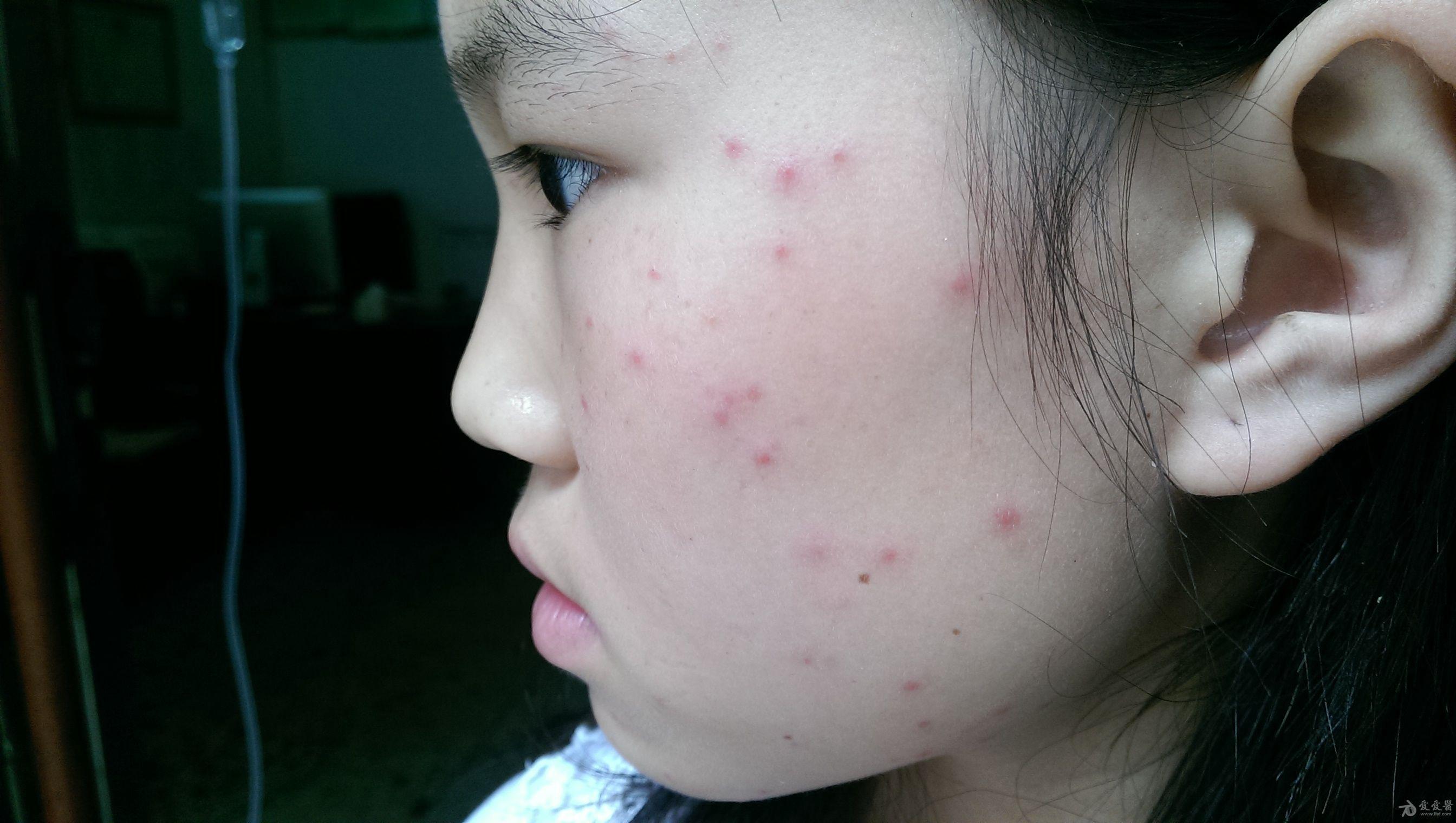 求助高手分析下这几张皮肤病图片看什么在线等