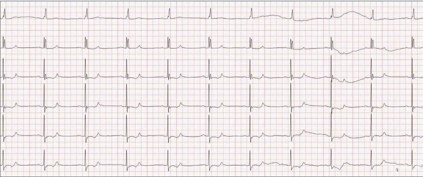 冬秋心电图讨论20150510逆行p波