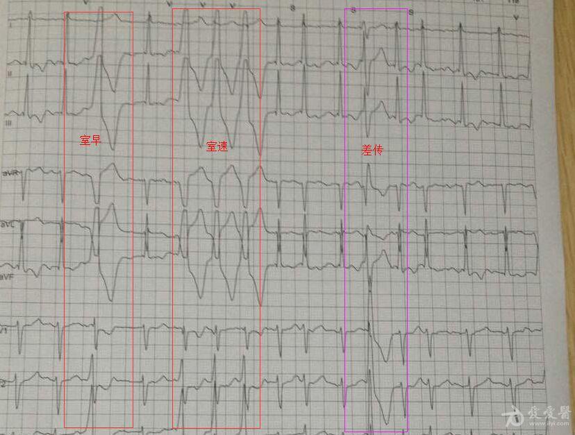 房顫伴室早還是差傳,每次都為這爭個不休,請老師指點 - 心電圖腦電圖