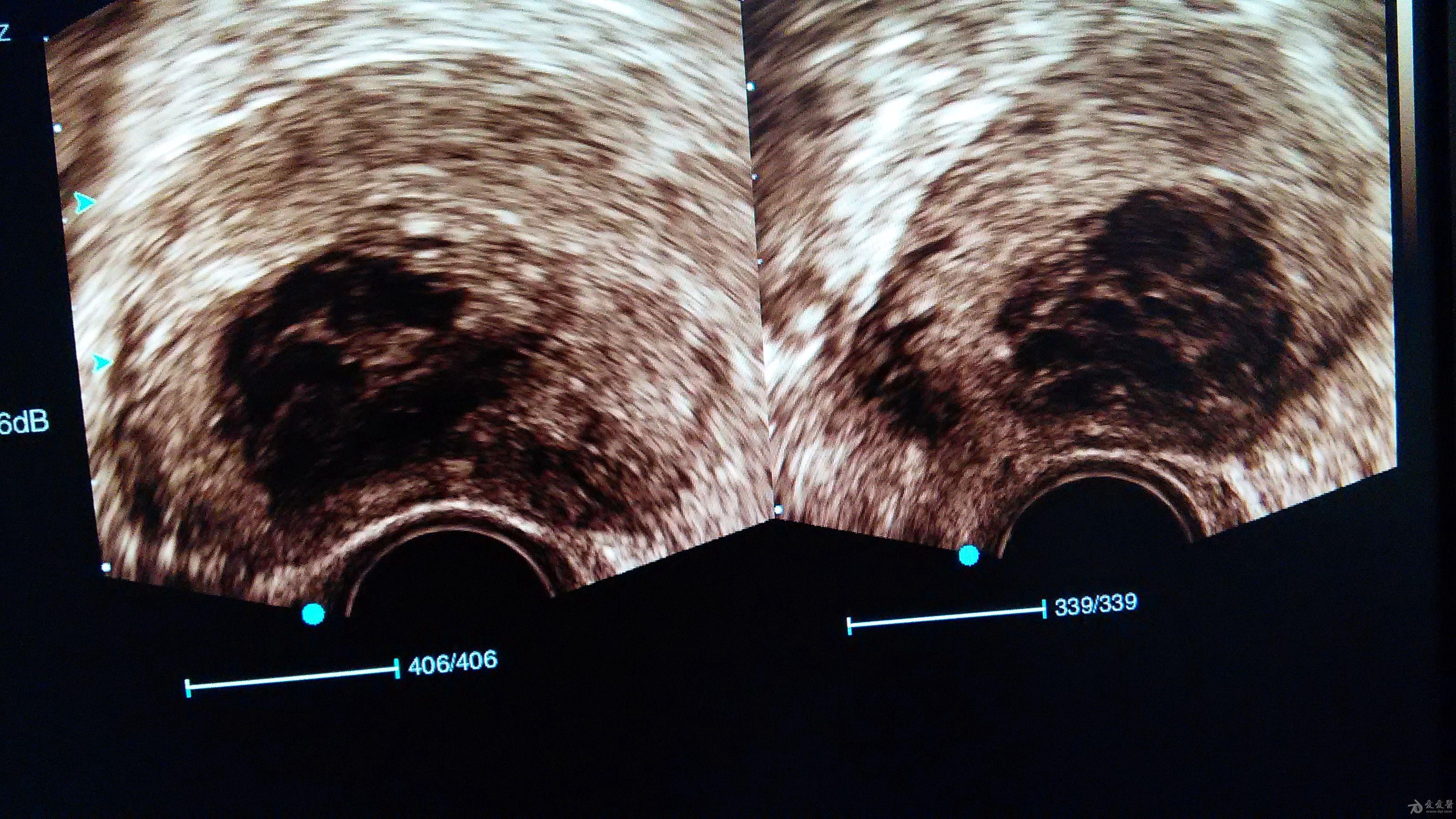 剖宫产瘢痕的超声图片图片