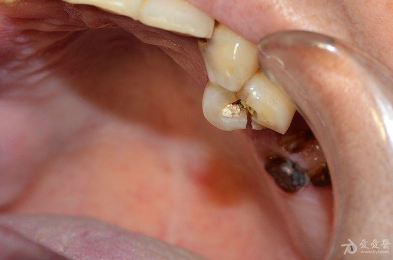 根管治疗中牙齿纵裂求助