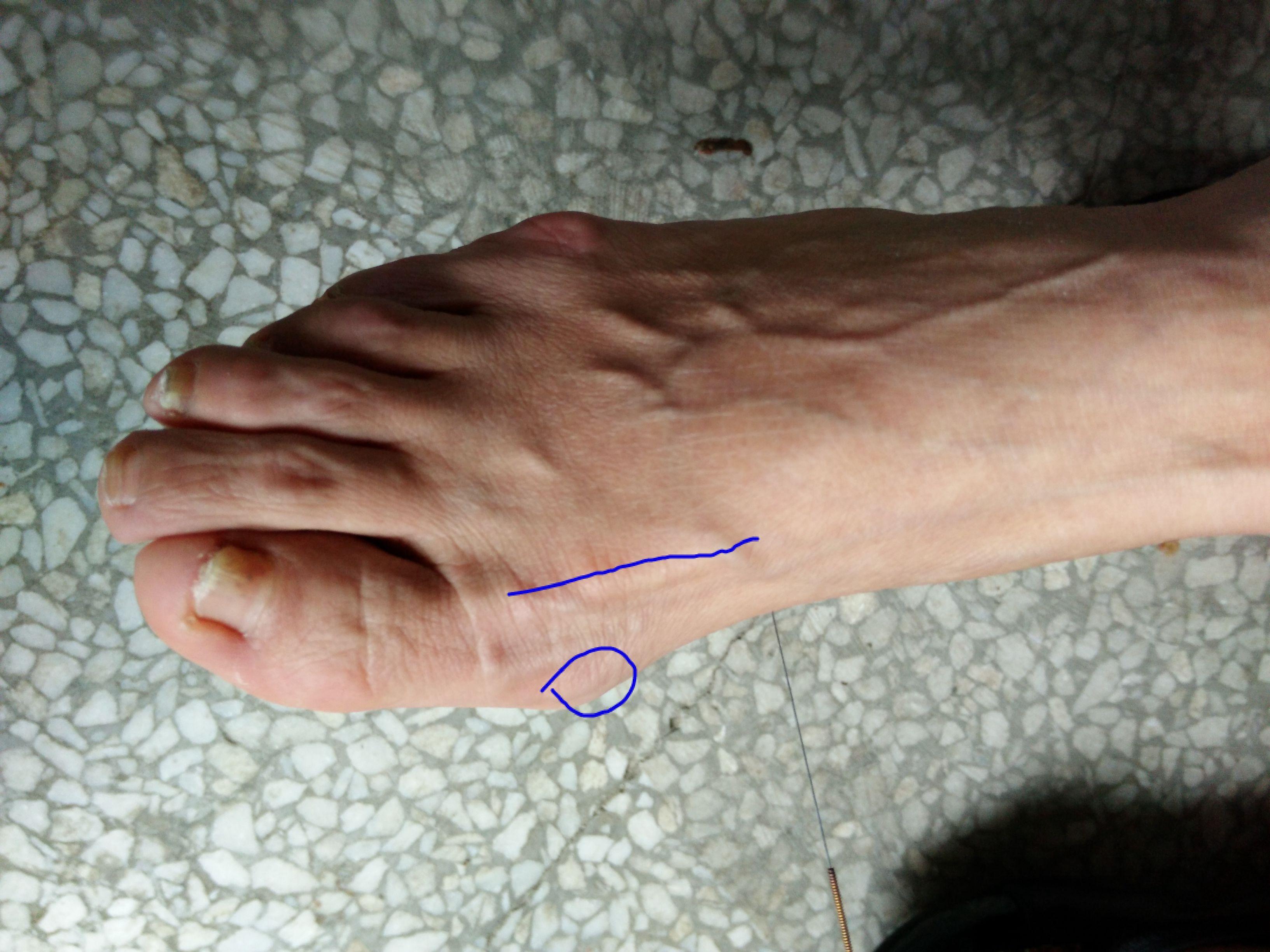 足拇趾弓状球纹图片