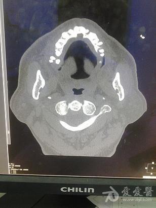 上頜骨多發囊性病變