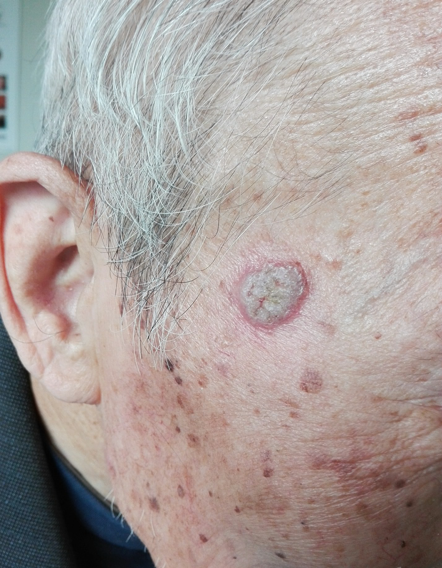 请老师看看啥皮肤病