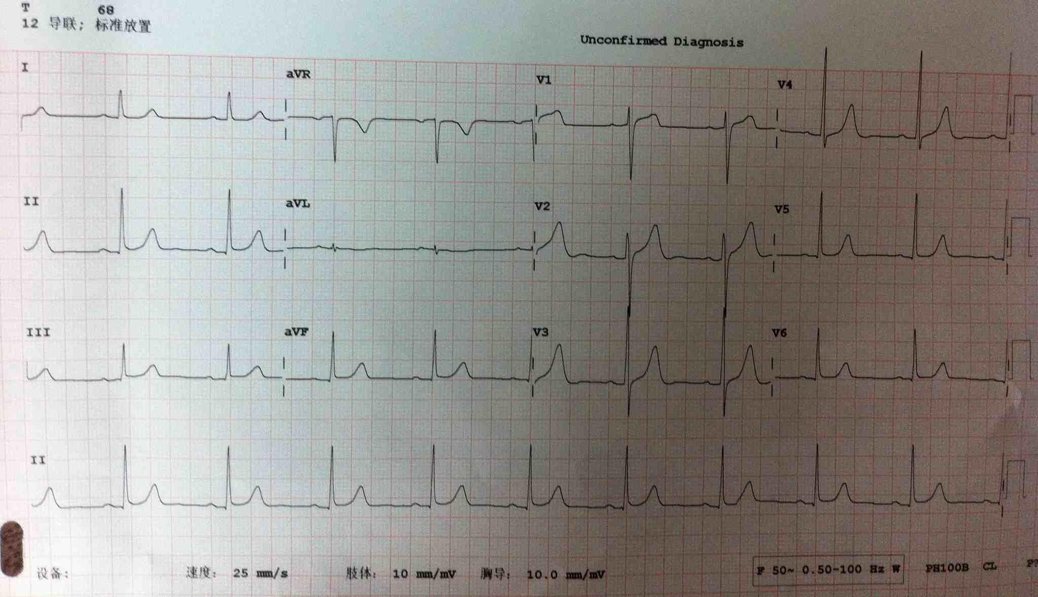 心电图st段轻微抬高图片