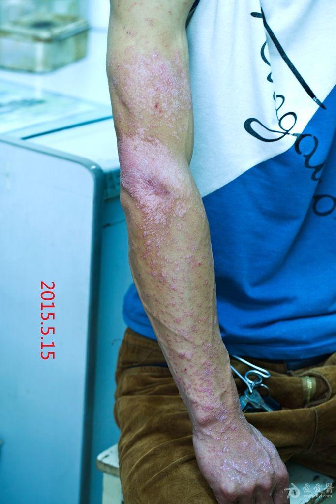 进行期银屑病一例