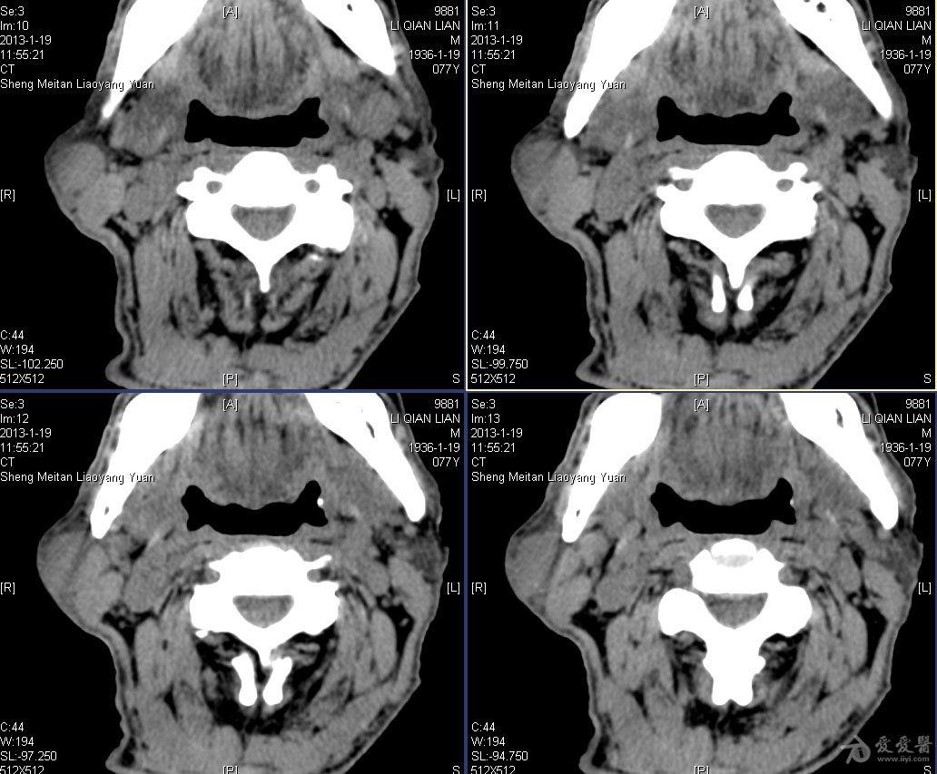 腮腺ct断层解剖图图片