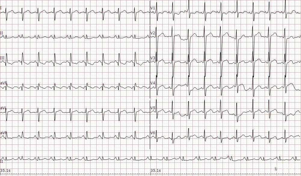 第一次心电图:窦速,右室肥厚.