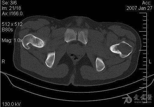 经典病例股骨大转子软骨母细胞瘤一例