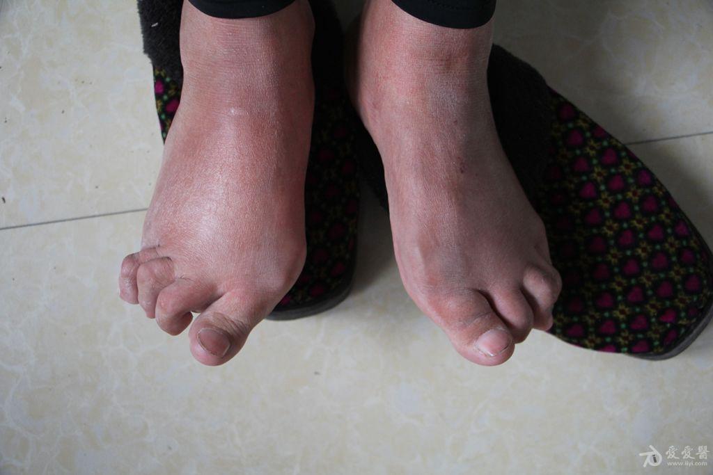 类风湿性关节炎图片