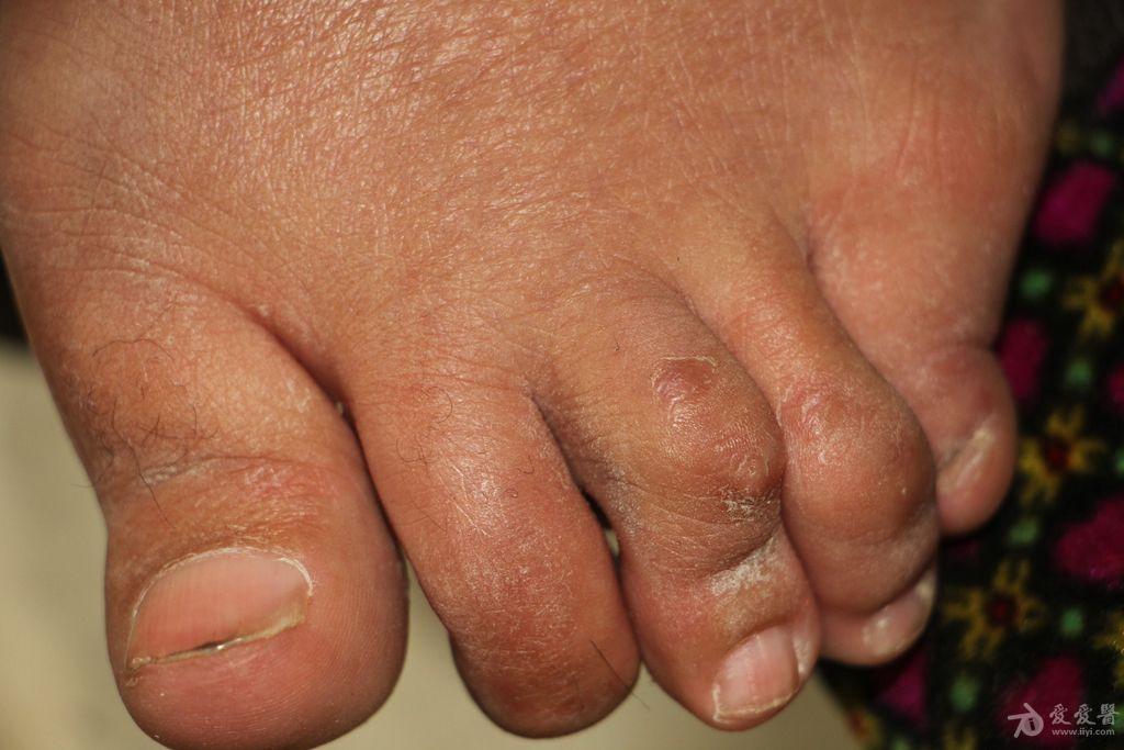 类风湿性关节炎图片