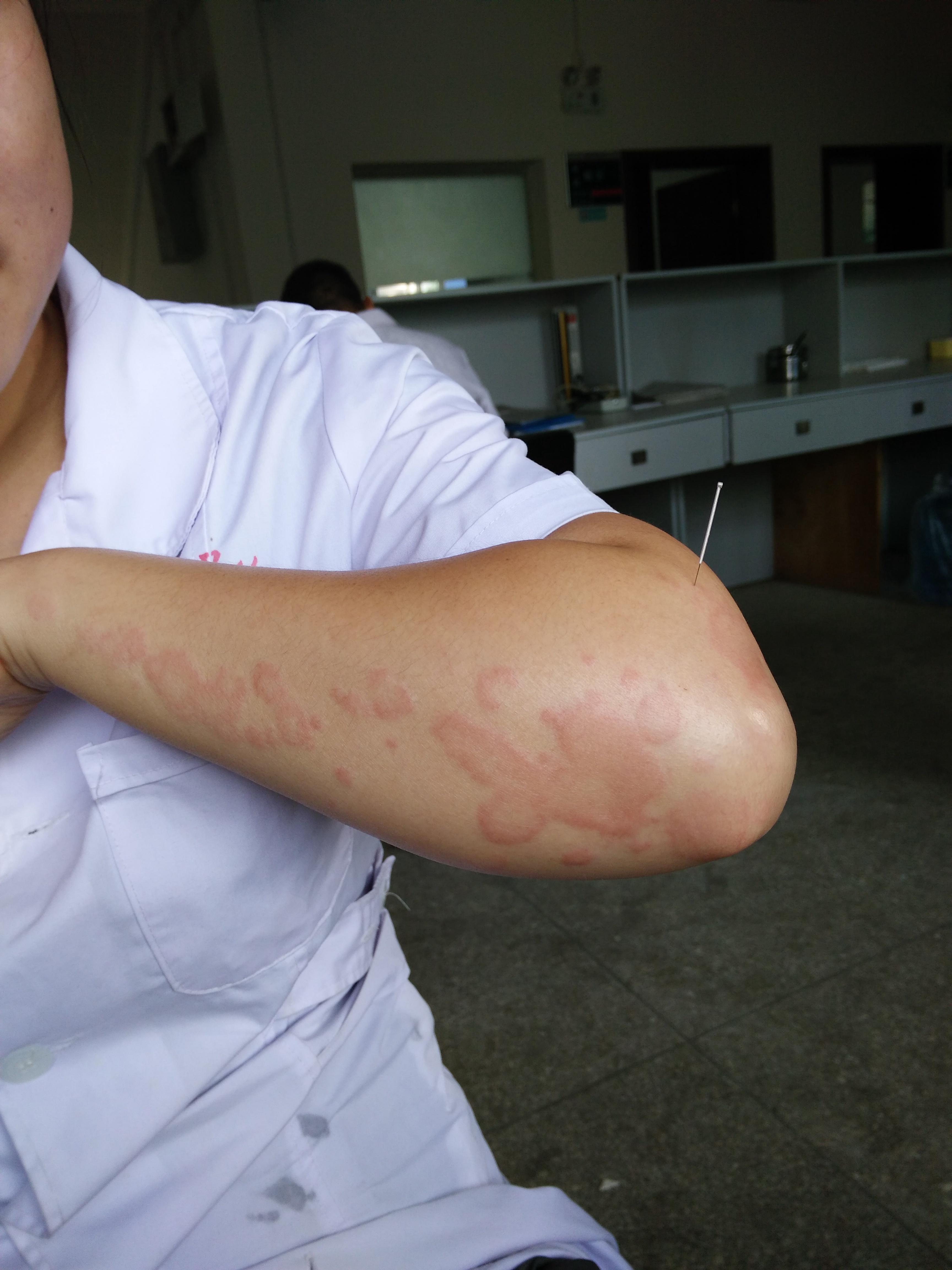 针灸处理急性荨麻疹